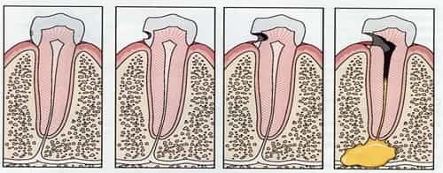 Dental decay or cavity progression