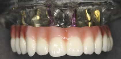 all in four denture implants