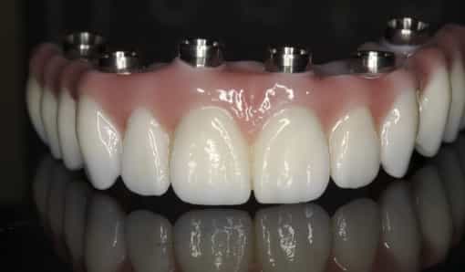All in four implant Zirconia teeth feel like your natural teeth and because of their strength you can use them like natural teeth, unlike the typical acrylic or plastic dentures.