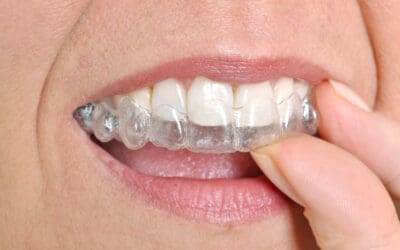 Dental Night Guard for Clenching: Reduce Stress and Save Your Teeth